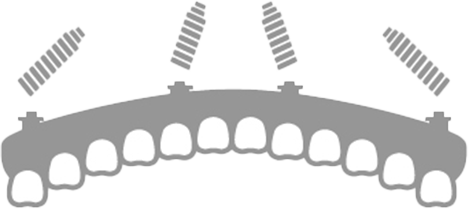 片あごインプラント